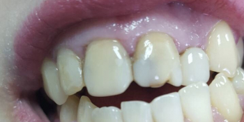 Лечение зубов без боли оренбург
